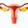 Consulta endometriosis